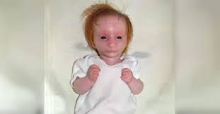 Image result for Nanismo Primordial