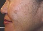 Hyperpigmentation – Prevention, Causes and Treatments | Makeup ...