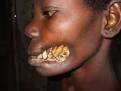 Tapeworm (Cestoda): Parasitic