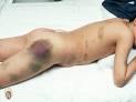 23. Petechiae, Purpura, and Ecchymoses d.