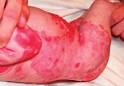 What is Epidermolysis Bullosa