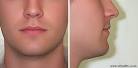 Virtual FFS: Chin