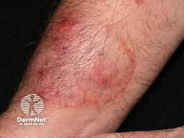 Image result for tinea corporis