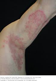 Image result for tinea corporis