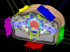 IMRT: <b>Intensity modulated</b>