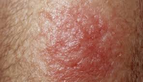 Image result for tinea corporis