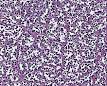 <b>Rhabdomyosarcoma</b> - Wikipedia