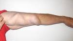 dialysis <b>fistula</b> | CHRONIC POSITIVITY - Life with Polycystic