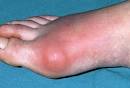 Gout Pictures Slideshow: Causes, Symptoms, and Treatments of Gout