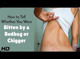 Image result for bed bug bites