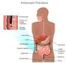 Gas in the Digestive Tract