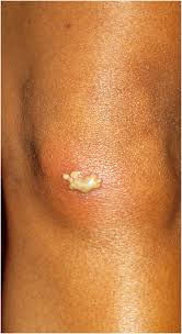 Attēlu rezultāti vaicājumam “Diderma simplex sessile”