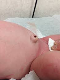 Attēlu rezultāti vaicājumam “Diderma umbilicatum young”