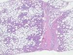 Subcutaneous <b>fat necrosis</b> of