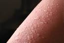 Natural Health And Beauty Tips: BLISTERS
