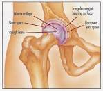 Arthritic <b>hip joint</b>