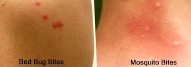 Image result for bed bug bites