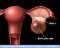 cervical cysts
