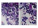 stromale <b>dell</b>'<b>endometrio</b>;