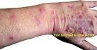 Dermatology: highly itchy soars on hands and arms, cutaneous ...