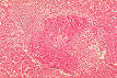 Brucellosis - Wikipedia, the free encyclopedia