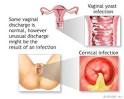 Vaginal Discharge