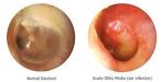 Ear Infections, fluid and hearing loss