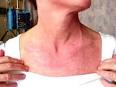 Inflammatory Myopathy