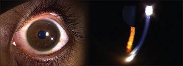 Kuvahaun tulos haulle Kayser-Fleischer