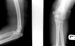 <b>Osteochondritis Dissecans</b>