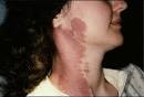 Picture of <b>Port</b>-<b>Wine Stain</b>