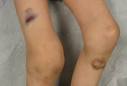 <b>Hemarthrosis</b>. Causes, symptoms, treatment <b>Hemarthrosis</b>