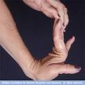MayoClinic.com Health Library - Ehlers-Danlos syndrome