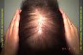 skin care: HAIR CYCLE---TELOGEN EFFLUVIUM