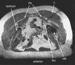 Attēlu rezultāti vaicājumam “Cribraria piriformis young”