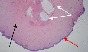 Attēlu rezultāti vaicājumam “Diderma umbilicatum young”
