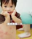 腸病毒典型常見症狀：