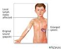 Cat scratch disease: MedlinePlus Medical Encyclopedia Image