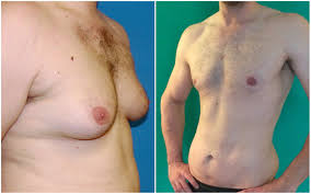 Image result for manboobs