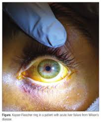 Kuvahaun tulos haulle Kayser-Fleischer