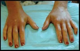 Attēlu rezultāti vaicājumam “Scleroderma”