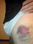 File:<b>Hematoma</b> by David