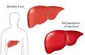 <b>Toxic hepatitis</b> refers to