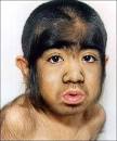 Werewolf Syndrome (source: