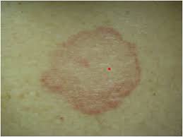 Image result for tinea corporis