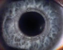 Ceratocone, ectasia, ectasia corneal, ectasia corneana, tratamento para ceratocone, cura para ceratocone, ceratocone avançado, ceratocone inicial, suspeita de ceratocone, lente para ceratocone, especialista em ceratocone, especialista ceratocone porto alegre, clinica especializada em ceratocone, oftalmologista ceratocone, oftalmologista para ceratocone, especializado em ceratocone, cone, córnea fina, cornea fina, córnea em forma de cone, cornea em forma de cone, ceratocone tratamento, ceratocone cirurgia, crosslink, cross link, crosslinking, cross linking, anel de ferrara