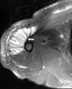 Myoglobinuria; Rhabdomyolysis