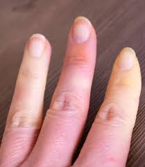 Attēlu rezultāti vaicājumam “Scleroderma”