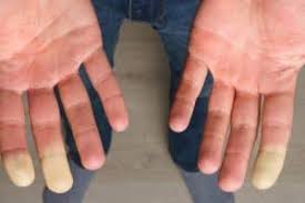 Attēlu rezultāti vaicājumam “Scleroderma”