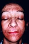 A case of granulomatous rosacea: Sorting granulomatous rosacea ...